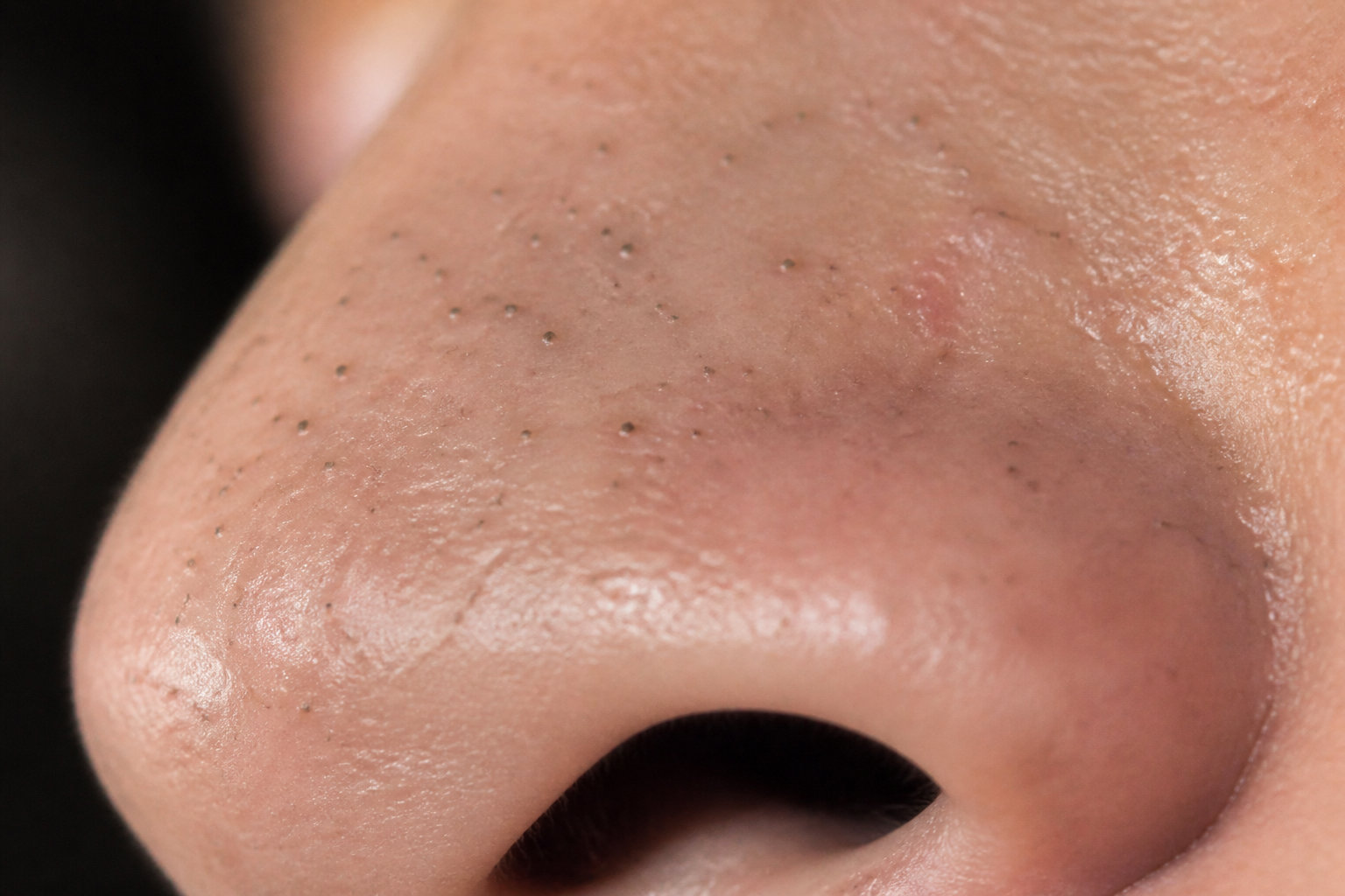 Pourquoi les points noirs s'invitent-ils sur votre visage ?